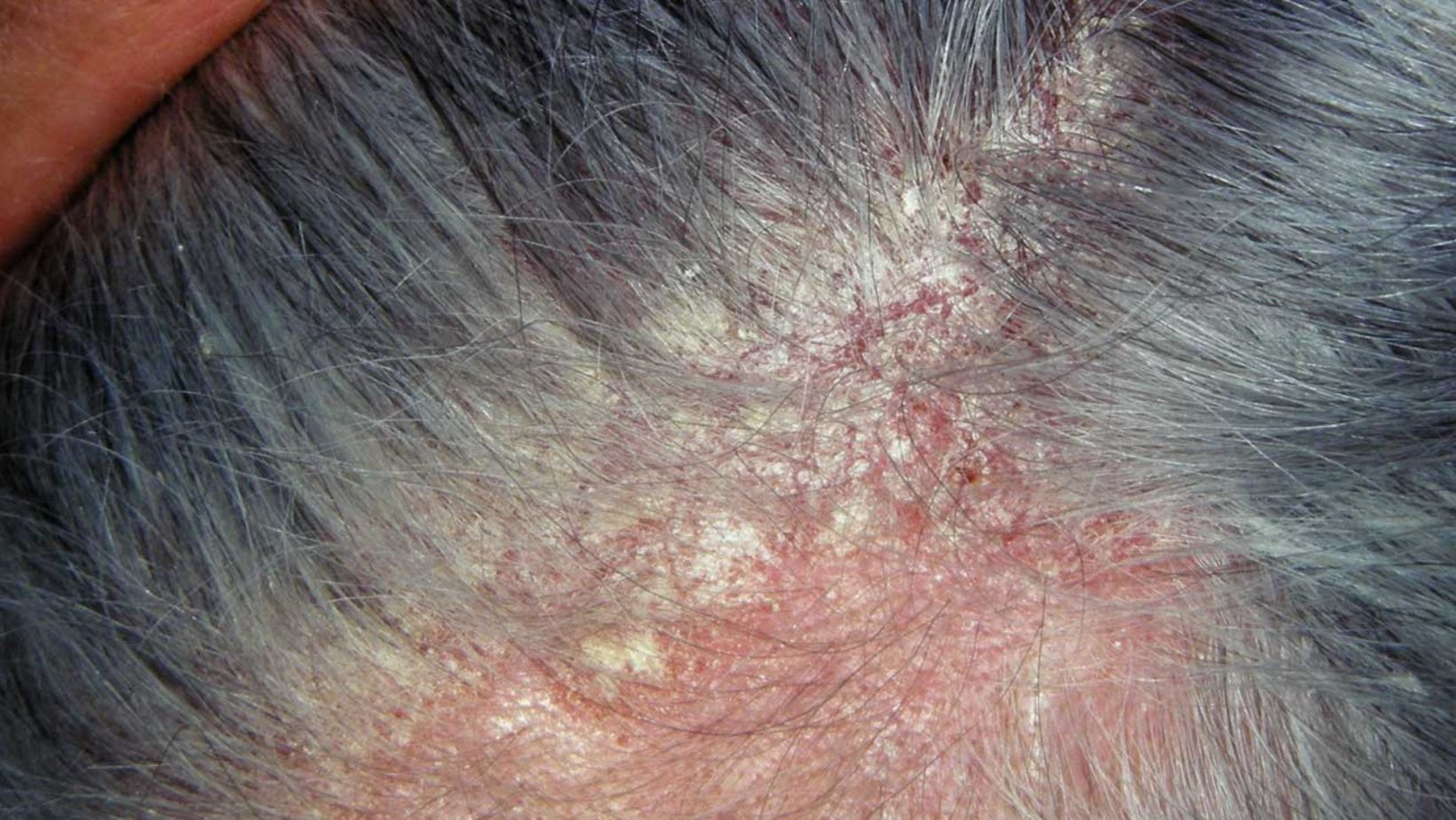 can eczema cause hair loss
